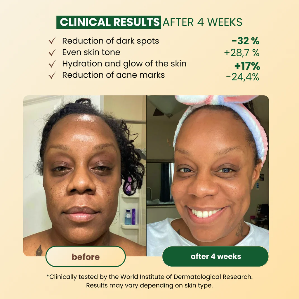 ✨ Advanced Anti-Spots & Dark Spot Correcting Soap — Hyperpigmentation Treatment for Face & Body, Melasma Fade Bar 🧼