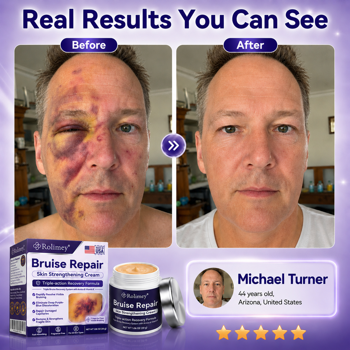 👨‍⚕️Over 100,000 units sold💕 - Cream to repair bruises and strengthen the skin.