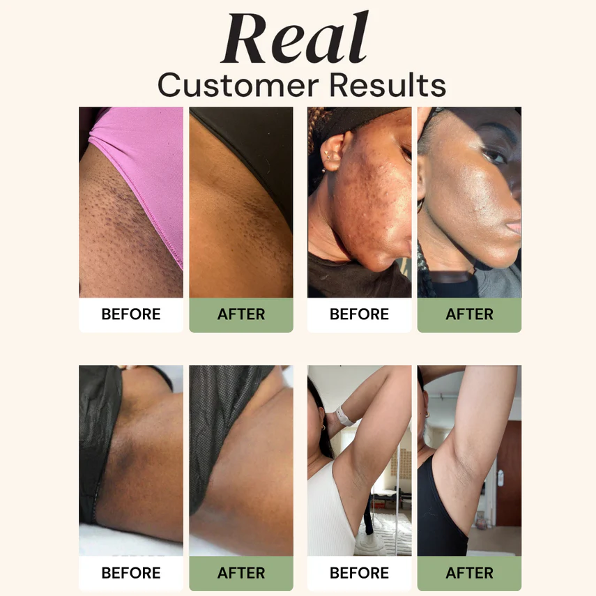 ✨ Advanced Anti-Spots & Dark Spot Correcting Soap — Hyperpigmentation Treatment for Face & Body, Melasma Fade Bar 🧼